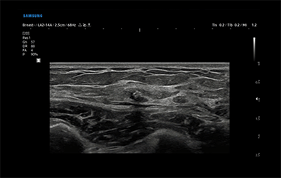 healthy breast 假体超声 img5