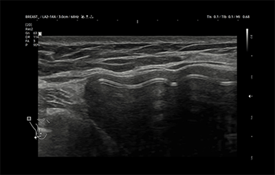 healthy breast 假体超声 img6
