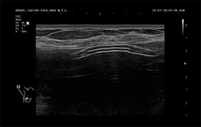 healthy breast 假体超声 img7
