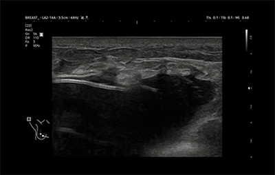 healthy breast 假体超声 img8