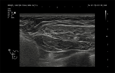 healthy breast 假体超声 img9
