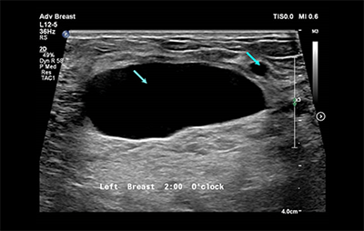 healthy breast 乳腺癌超声 img10