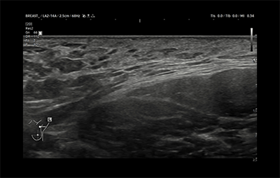 healthy breast 乳腺癌超声 img11