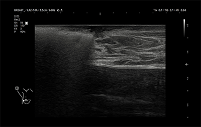 healthy breast 乳腺癌超声 img12