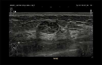 healthy breast 乳腺癌超声 img7