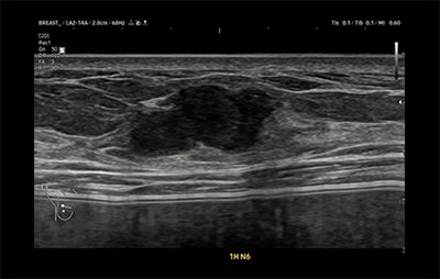 healthy breast 乳腺癌超声 img8