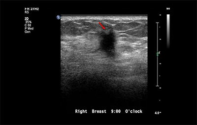 healthy breast 乳腺癌超声 img9